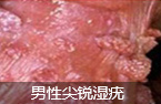 生殖器长赘物是什么病?如何治疗?-lni