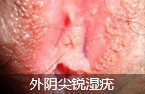 生殖器长赘物是什么病?如何治疗?-lni