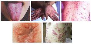 医生详解:女人惹上性传播疾病的五大迹象-lni